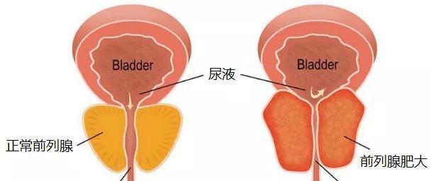 夜尿多的原因及解决方法探究（为什么会出现夜尿多）